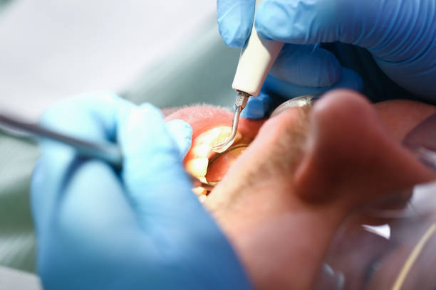 Best Emergency Treatment for Dental Infections or Abscesses in Walnut, CA