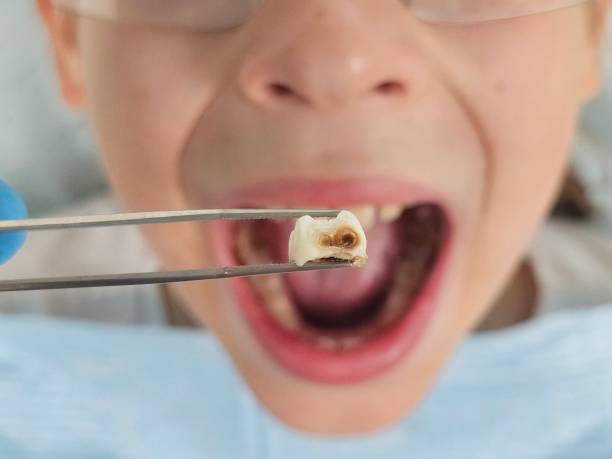 Best Emergency Treatment for Dental Infections or Abscesses in Walnut, CA